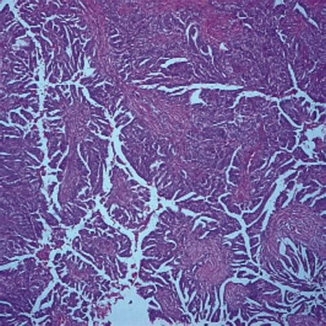 Moderate Differentiated Adenocarcinoma Of The Rectosigmoid Junction Download Scientific