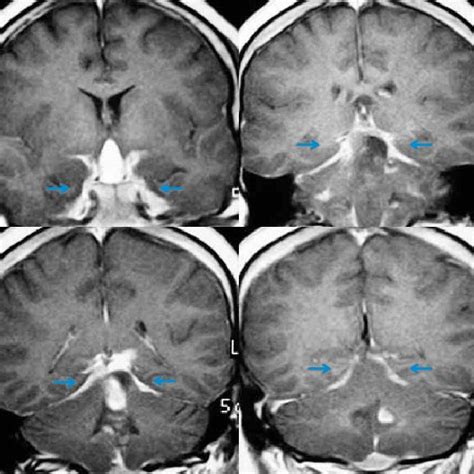 Rmn Cerebral Durante El Per Odo De Observaci N Radiol Gica Esta