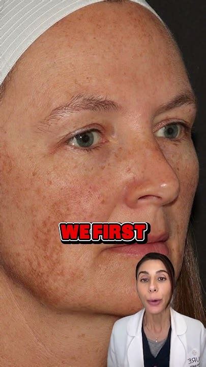 The Most Common Triggers For Melasma Youtube