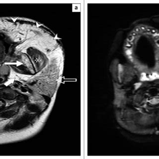 (a) Axial T2W MRI image of the posterior fossa demonstrates enlargement ...