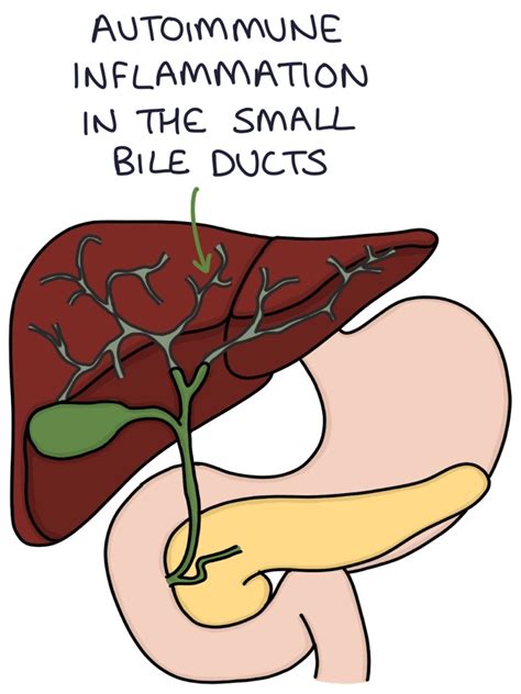 Primary Biliary Cholangitis Zero To Finals