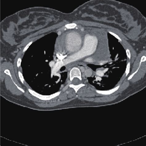 Ascending Aortic Dissection Download Scientific Diagram