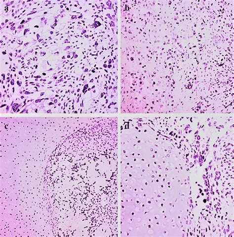 A Epithelioid Spindle Atypical Neuroepithelial Cells Hematoxylin And