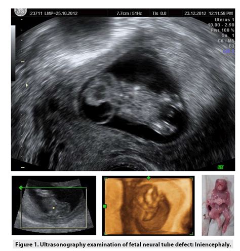 Neural Tube Defects Ultrasound