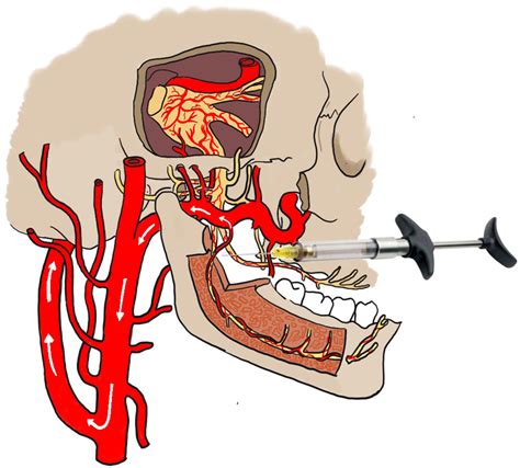 Intravascular Spread Of Local Anaesthesia From The Inferior Alveolar Download Scientific