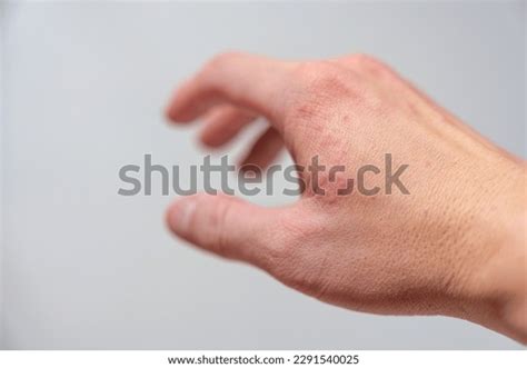 Allergic Reaction Red Rash Itychy On Stock Photo 2291540025 | Shutterstock