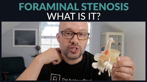 What Is Foraminal Stenosis And How To Find Relief Youtube