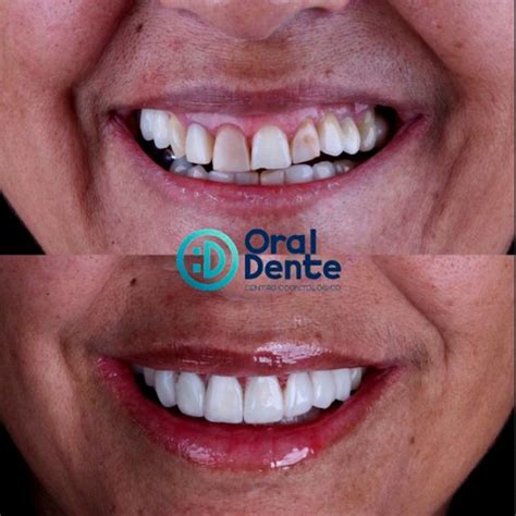 Antes E Depois De Facetas Em Resina Oral Dente