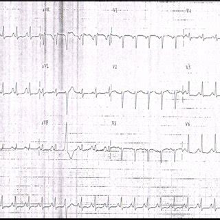 A 12 Lead Electrocardiogram Showing Sinus Tachycardia Left Atrial