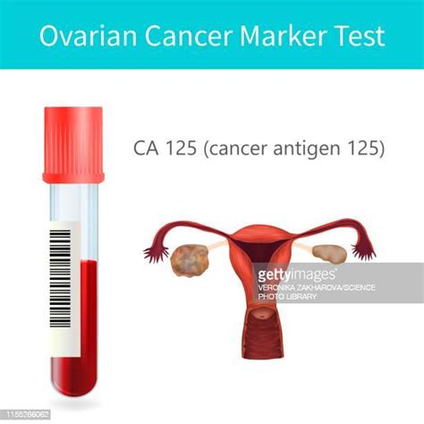 Ovarian Cancer Checkup Photos And Premium High Res Pictures Getty Images