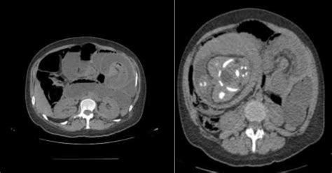 Axial View Of The Ct Scan Showing Jejunojejunal Intussusception With Download Scientific