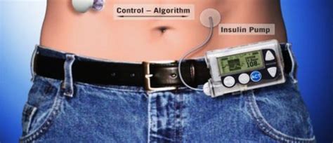 Implantable Insulin Pump Market Growth Size Share Trends And Forecast 2032 By Lester Mar