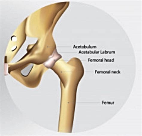 Symptoms and Treatment of Hip Arthrosis - MEDELIT UK