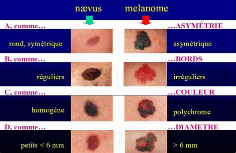 Cancer De La Peau D Finition Sympt Mes Traitements Institut Amelis