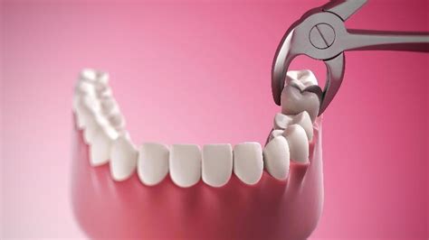 Tips For After Your Dental Extractions | White Park Dental | Blog