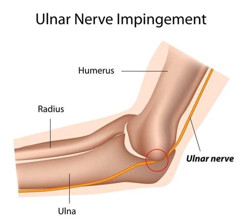 What Are The Treatment Options For Ulnar Nerve Entrapment Orthopaedics Toronto Orthoto