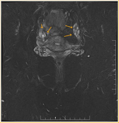 Acute Pid Mri Sumers Radiology Blog