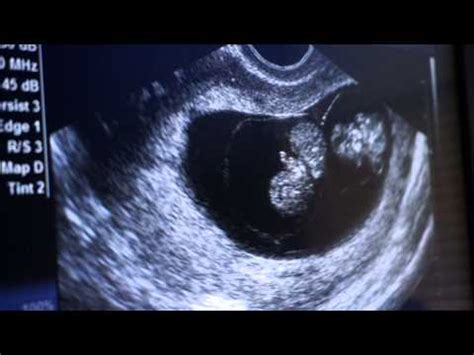 8 Week Ultrasound Hidden Twins