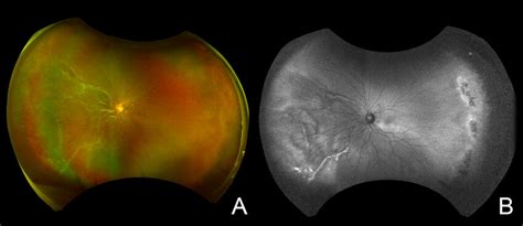 Preoperative Widefield Fundus Photograph And Fundus Autofluorescence