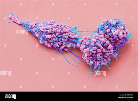 Ovarian Cancer Cells Coloured Scanning Electron Micrograph Sem Of Ovarian Cancer Cells