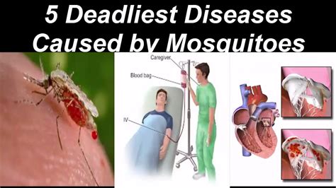 5 Deadliest Diseases Caused By Mosquitoes Top 10 Deadliest Diseases