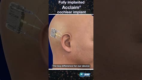 How Does It Work Cochlear Implant Fully Under Skin To Undergo Clinical