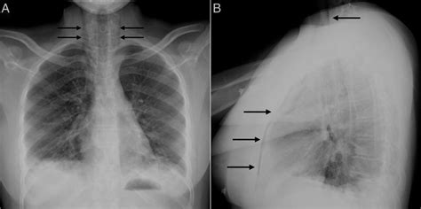 Chest X-ray showing signs of pneumomediastinum that extends to the ...