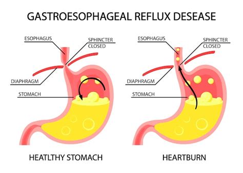 Enfermedad Por Reflujo Gastroesofágico Del Estómago Humano Erge Acidez