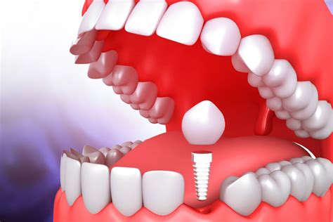 How Are Same Day Dental Implants Even Possible? | Aria Dental