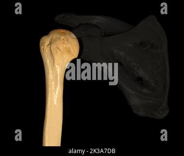 Ct Shoulder D Of Computed Tomography Volume Rendering Examination Of