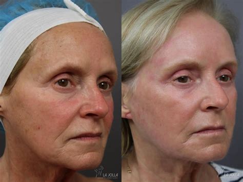 Laser Skin Resurfacing In San Diego La Jolla Cosmetic Laser Clinic