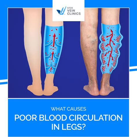 How Bad Leg Circulation Affects Your Vascular Health Usa Vein Clinics