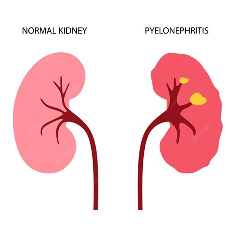 Premium Vector Kidney Disease Concept