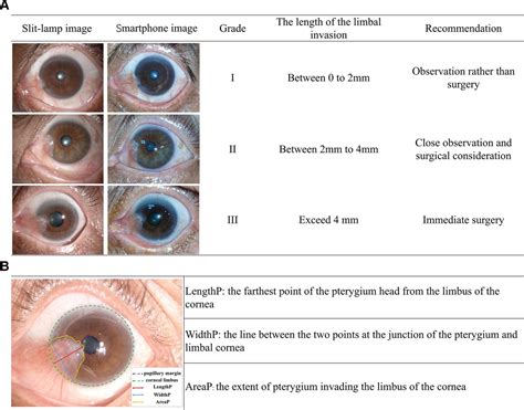 Pterygium