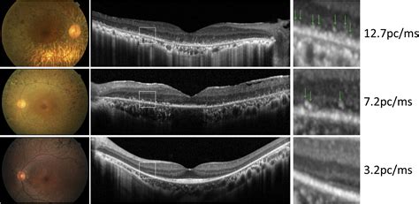 Number Of Hyperreflective Foci In The Outer Retina Correlates With