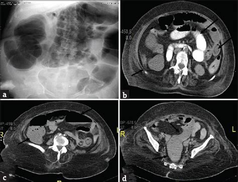 Large Bowel Obstruction In The Emergency Department Imaging Spectrum