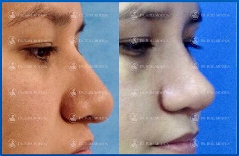 Rinoplastia Caso 68 Nariz Fibroadiposa Mas D Ti Facial