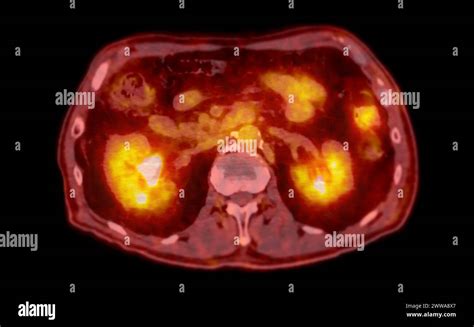 A Pet Ct Scan Image Is A Diagnostic Visualization Combining Positron