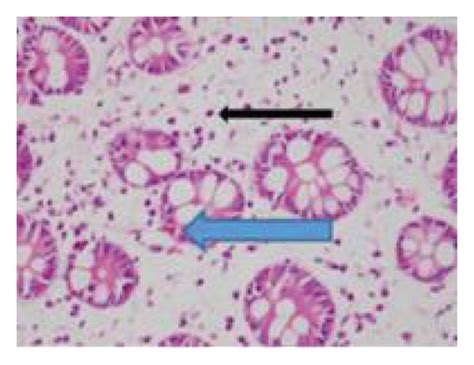 Histologic Findings Of Duodenal Biopsy The Duodenum Mucosa Shows A Download Scientific