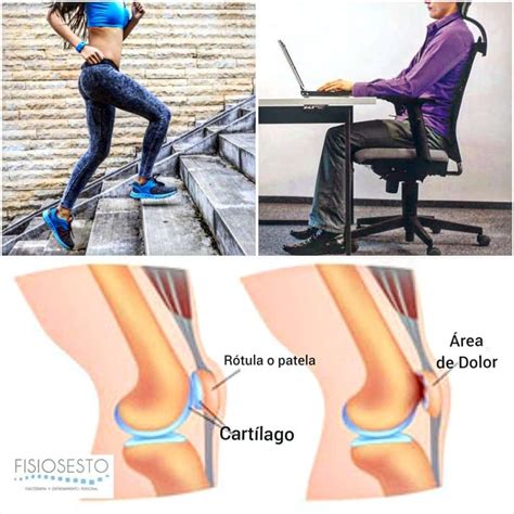 S Ndrome Femoropatelar Tratamiento Y Ejercicios En Fisioterapia