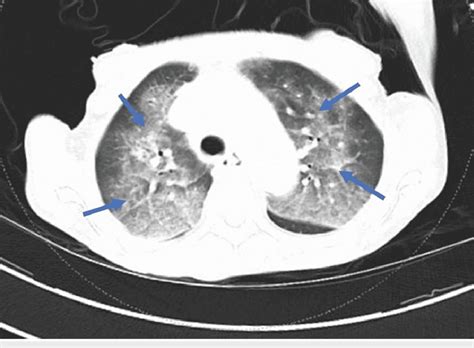 Ct Chest Showing Septal Thickenings And Patchy Acinar Opacities In The