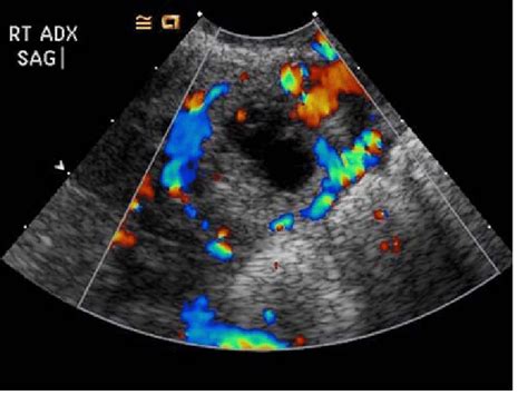 Ovarian Ectopic Ultrasound