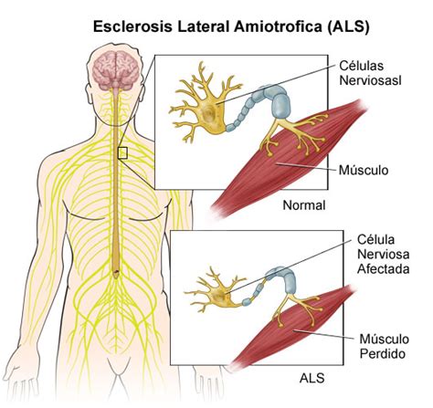 Esclerosis Lateral Amiotrófica Fisioterapia Magallanes Clinica de