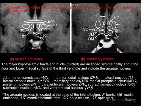 Mri Imaging Hypothalamus Dr Ahmed Esawy Ppt