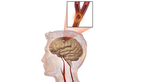 Conoce Las Causas Y Consecuencias De La Isquemia Cerebral TiTi