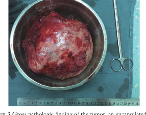 Figure 1 From Giant Thymoma Successfully Resected Via Hemiclamshell