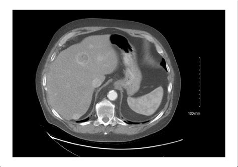 Computed Tomography Of The Liver Showing Multiple Liver Lesions