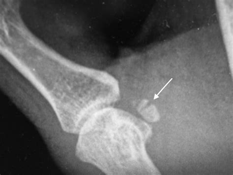 Tripartite Fracture Of The Ulnar Sesamoid Bone Of The Thumb Journal Of Emergency Medicine