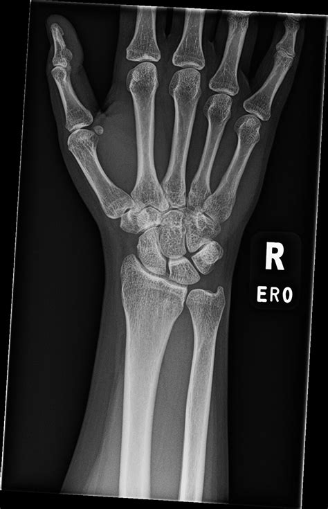 Orthodx Occult Scaphoid Fracture Clinical Advisor