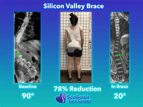 Silicon Valley Scoliosis Back Brace Scoliosis Care Centers